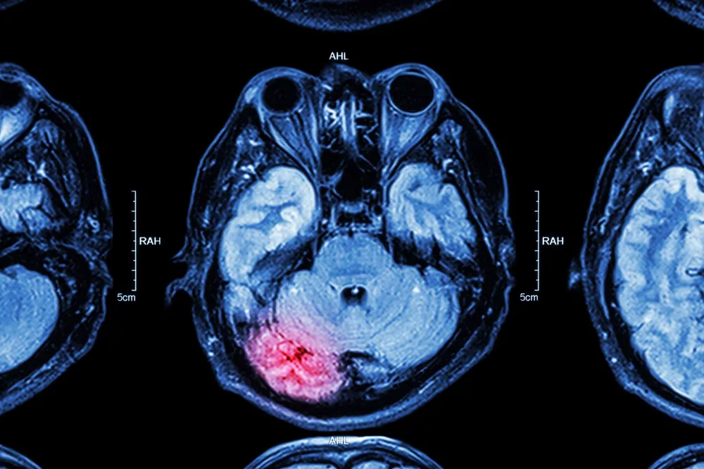 Brain MRI imaging showing traumatic brain injury - Atlanta TBI attorney